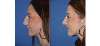 Rhinoplasty Patient Stories