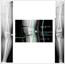Knie Achsenfehlstellung Der Beine X O Beine Roland Klinik