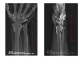 Image result for Wrist XRay