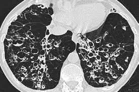 Cystic expansion of the remaining prostate tissue in the peripheral zone, focal squamous 9. Http Cdn Intechopen Com Pdfs 34276 Intech Radiological Features Of Cystic Fibrosis Pdf