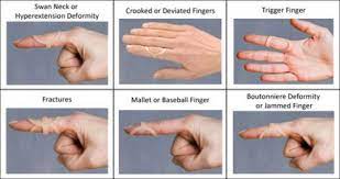 Pin By Selket Myles On Splints Postpartum Care Kit Hand Therapy Ehlers Danlos Syndrome Hypermobility