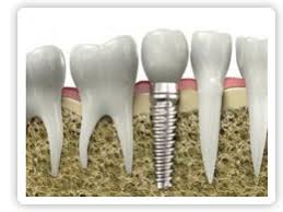 L'implantation dentaire vous redonnera le confort et l'esthétique des dents naturelles. Implant Hongrie Le Meilleur Prix A Budapest