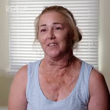 An incredibly emotional moment as Dr Lee successfully removes multiple  painful cysts, something 20 dermatologists couldn’t do 🤩 #DrPimplePopper