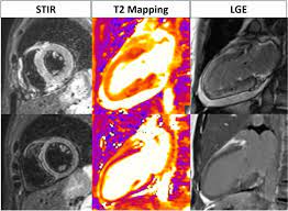 The mri myocarditis protocol encompasses a set of different mri sequences for the cardiac assessment in case of suspected myocardial inflammation. Myocarditis Imaging Up To Date Springerlink