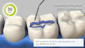 Indications d'ibond self etch ■■ ■■ ■■ collage de composites directs photopolymérisables. How To Use Ibond Universal In Total Etch Selective Enamel Etch And Self Etch Technique En Youtube