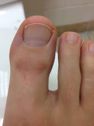 Dry skin on legs is much easier to deal with than you might have thought, and we talked to a celebrity skincare expert to see how to banish dry skin. Dry Skin On Top Of Big Toe How You Can Do It At Home Pictures Designs Dry Skin On Top Of Big Toe For You The Nail For You
