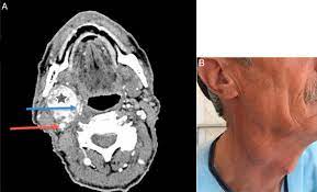 A Spiral Neck Ct Scan With Iv Contrast Shows Cbt Star Ica Red Download Scientific Diagram