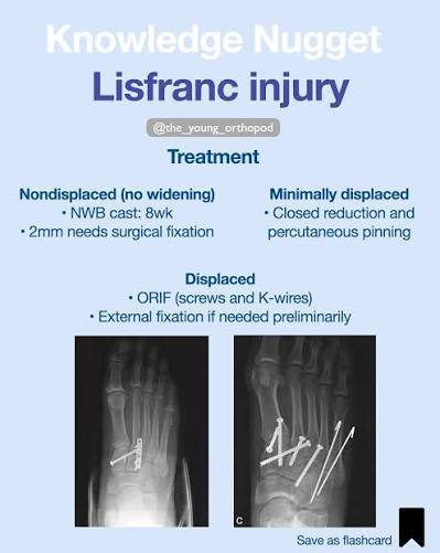 Details in Caption🔥🔥 ✓Save for later! ✓ Lisfranc injury 📌Lisfranc  ligament connects medial (shortest) cuneiform to second (longest)  metatarsal. 📌A Lisfranc injury is a tarsometatarsal fracture dislocation  characterized by traumatic disruption between