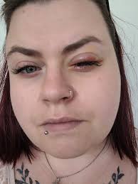 Im very accident prone its ridiculous. This was the time i sliced inside my  eye with a birthday card 🙃 3 years