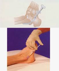 Image result for Tendon Sheath Injection