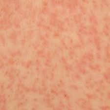 Skin Rash 68 Pictures Causes And Treatments