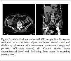 Image result for Neutropenic Colitis