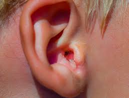 Check spelling or type a new query. How Can I Tell If I Have A Nasal Fracture 150 Harley Street Ent