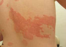 Image result for koebner phenomenon psoriasis