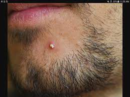 Pustule Nose Ring Skin Types Skin