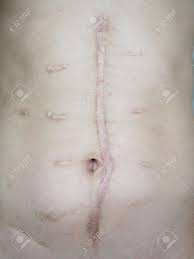 Cicatrices Su Después De La Cirugía Fotos, retratos, imágenes y fotografía  de archivo libres de derecho. Image 78617774