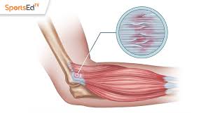 Most people with tennis elbow (lateral epicondylitis) did not acquire the condition from playing the game. Ouch Is That Tennis Elbow Sportsedtv