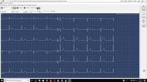 Die genauigkeit der neuen cardiogoniometrie ist mit der kernspintomografie vergleichbar. Untersuchungen Kardiologie Dr Bettina Koller Munchen