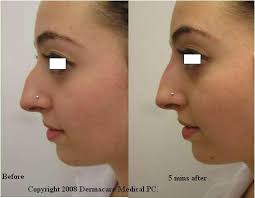 New York Non Surgical Nose Job