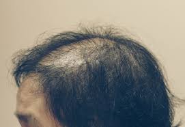Losing handfuls of hair (not the usual amount you see in the shower). 15 769 Female Hair Loss Stock Photos And Images 123rf