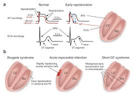 Left cardiac sympathethic denervation in therapy of congenital long qt syndrome. Sudden Cardio Arrest When Normal Ecg Variants Turn Lethal Nature Medicine