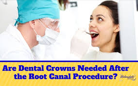 In some cases, existing dental insurance will cover 80% of a root canal procedure's cost. Do You Need A Dental Crown After Root Canal Procedure