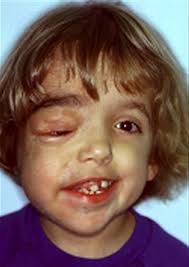 Image result for phlegmon on face)