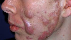 Acne Conglobata Symptoms Causes Treatment And More