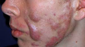 Mild acne is characterized by minor breakouts which don't cover an entire area, however, if left untreated, it can develop into more severe acne if your breakouts are moderate rather than mild, they may involve more areas of the body, and may result in pustules (red pimples with white tops. Acne Conglobata Symptoms Causes Treatment And More