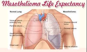 What Is The Life Expectancy Of A Person With Mesothelioma Disease Mesothelioma Life Expectancy No Mesothelioma What Is Life About Life Expectancy