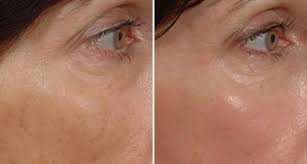 At regal skin and laser, our goal is to help you restore your youthful beauty using state of the art medical aesthetic treatments with an artistic touch. Laser Light Treatment Olympia Tacoma Gig Harbor Wa