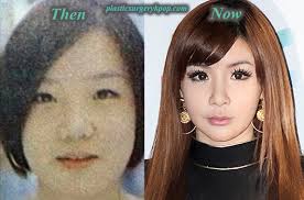 Park bom is well known as a member of 2ne1. Park Bom 2ne1 Plastic Surgery Before And After Pictures