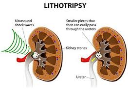 Urology Care Foundation How Are Kidney Stones Treated Kidney Stones Symptoms Kidney Kidney Cyst