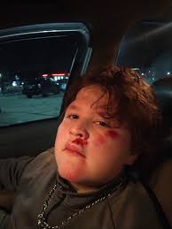 BMX rider suffers tricep injury in east Tennessee crash