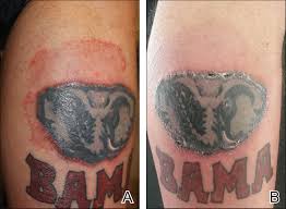 They hurt sometimes, don't really itch and are sometimes sore to the touch. Tinea Incognito In A Tattoo Mdedge Dermatology