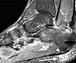 Tucker, ga, chapter 20, 1995; Plantar Fasciitis Radsource