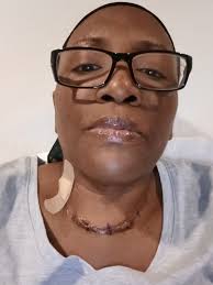 Seeking ENT/Laryngologist recommendations for vocal chord recovery