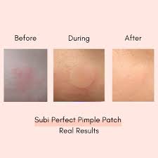 Try a pimple patch, which is a flat,. Subi Perfect Pimple Patch Pimples Beauty Routines Beauty Skin Care Routine