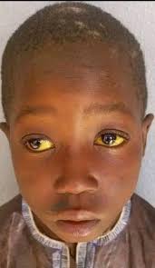 What is causing my angel fish's cloudy eye and how to treat it?