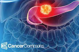 And what do skin cancer survival rates tell us? Pancreatic Cancer Survival Rates What Do They Really Mean Cancer Commons