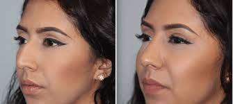 Facial Plastic Surgeon Orange County