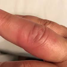 Entsteht so eine thrombose auch durch schlichtes abklemmen von gliedmaßen und wenn ja, kann ich was dagegen tun und kann auch eine. Finger Rot Und Geschwollen Welche Ursache Gesundheit Und Medizin Krankheit Hand