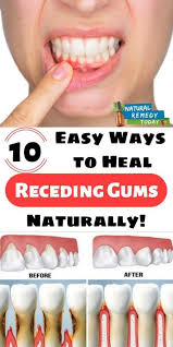 10 Easy Ways To Heal Receding Gums Naturally Did You Know That Your Dental Health Is Directly Related To Your Over Teeth Health Receding Gums Dental Health