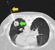 Image result for lung cancer xray