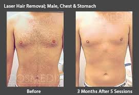 You can greatly reduce the risk of possible side effects by having your treatment performed by a medical doctor who is extremely skilled in using lasers and has. Laser Hair Removal Specialists In Sydney Cosmedix Clinics