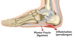 Berikut ini adalah arti, makna, pengertian, definisi dari kata tulang menurut kamus besar bahasa indonesia (kbbi) online dan menurut para ahli bahasa. Nyeri Pada Telapak Kaki Akibat Plantar Fasciitis