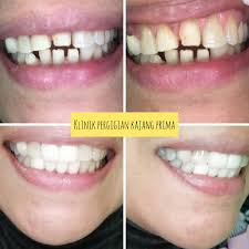 Klinik is very clean and neat, dr. Klinik Pergigian Kajang Prima Saya Taknak Pakai Gigi Palsu Doktor Gigi Saya Tak Berapa Nak Teratur La Tapi Saya Taknak Pakai Braces Saya Nak Yang Cepat Dan Boleh Memudahkan Hidup