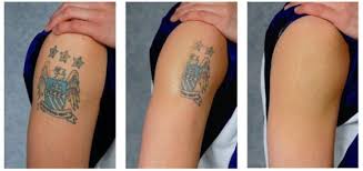 Tattoo Removal Methods That Work Diy Tattoo Permanent Diy Tattoo Tattoo Removal Cost