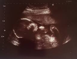 Durch die nase geblasen > blown th. Ultraschallbild Ohne Nase November 2014 Babyclub Babycenter