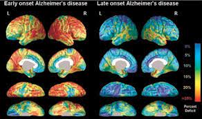 Brain Atrophy In Alzheimer S Disease And Aging Sciencedirect